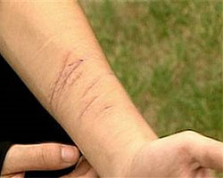 A picture of a forearm with semi-healed scratch marks on it.
